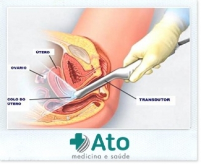 Ultrassom Transvaginal Doppler