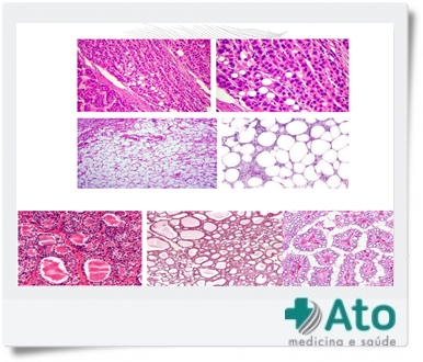 DIFERENÇA TUMOR E NEOPLASIA 