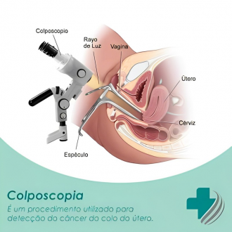 Para que Serve o Exame de Colposcopia